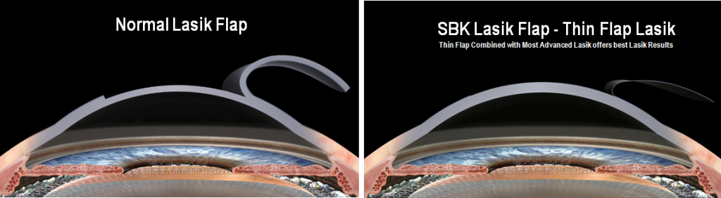 SBK Lasik Laser Eye Surgery in Mumbai