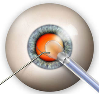 clear lens extraction surgery in mumbai