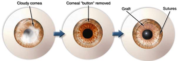 Corneal Transplant Surgery in India