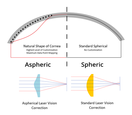 Advanced-Aspheric-Lasik-vs-Standard-Lasik