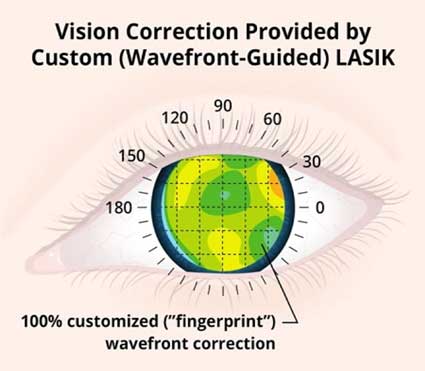 Customized-Lasik-vs-Standard-Lasik in Mumbai