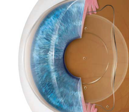 Implantable Contact Lens (ICL) Surgery in Mumbai