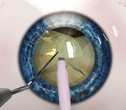 Cataract Surgery in Mumbai